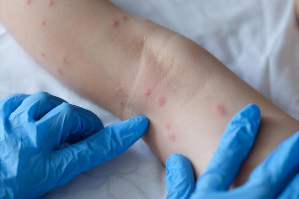 Una “nuova cura“ per combattere l'aumento di casi di scabbia
