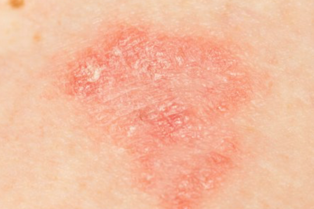 Dermatite atopica, consulti gratuiti all'ospedale Piero Palagi di Firenze