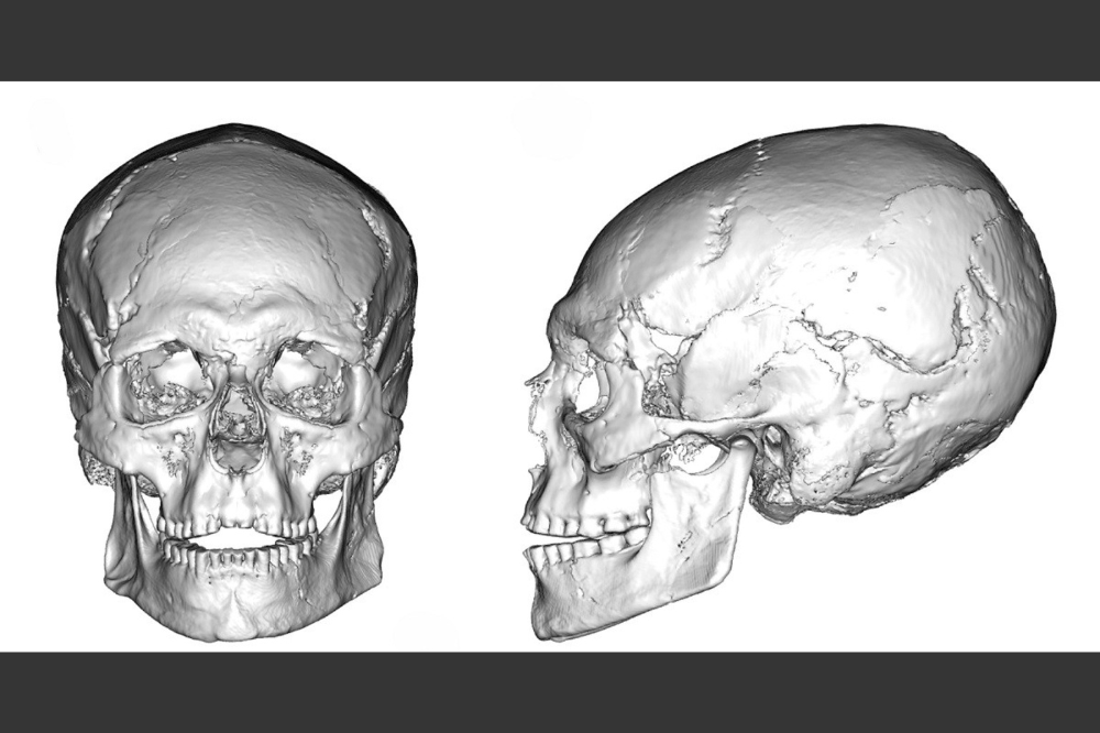 Cranio di 12.000 anni svela la pratica intenzionale di deformazione